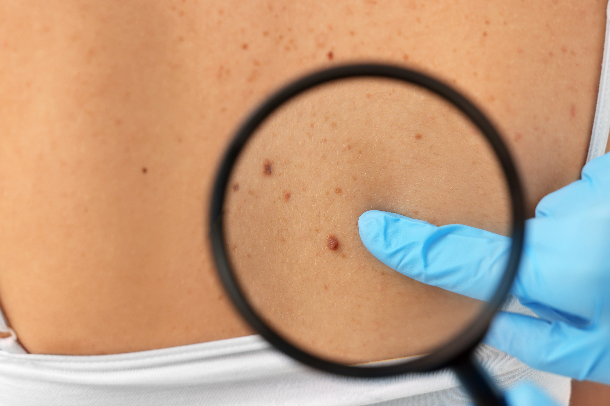Dermatologija Ljubljana mi je pomagala rešiti težavo s kožo